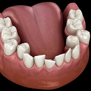 Illustration of crooked teeth