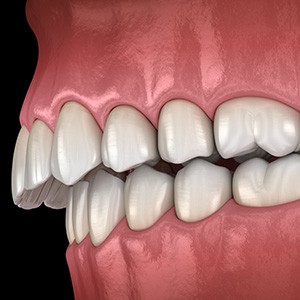 Illustration of an overbite