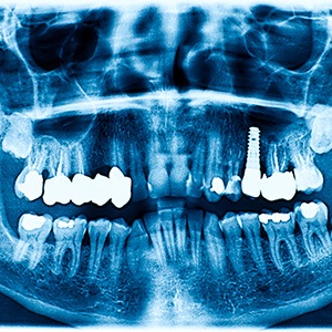 osseointegration is where your dental implant permanently fuses with your jawbone