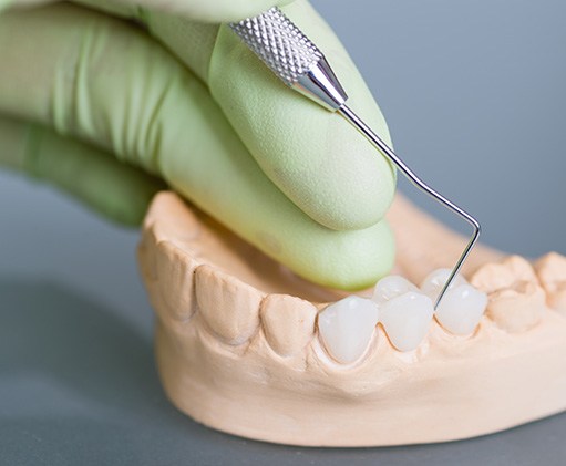 Green-gloved hand building dental bridge on model teeth