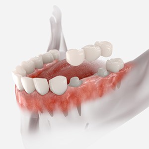 Rendering of dental bridge over abutment teeth in lower jaw with white background