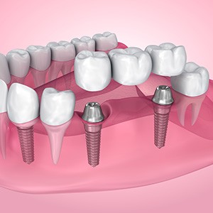 Rendering of implant bridge in lower arch with pink background