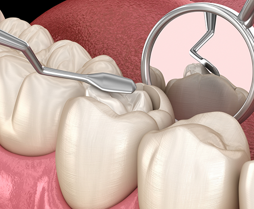 Illustration of the center portion of a tooth being removed