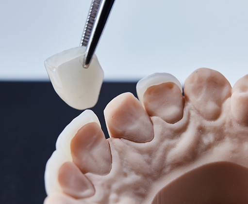 Tweezers placing a veneer over the front surface of a model of a tooth