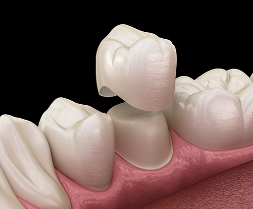 An illustration of a dental crown being placed over a damaged tooth 