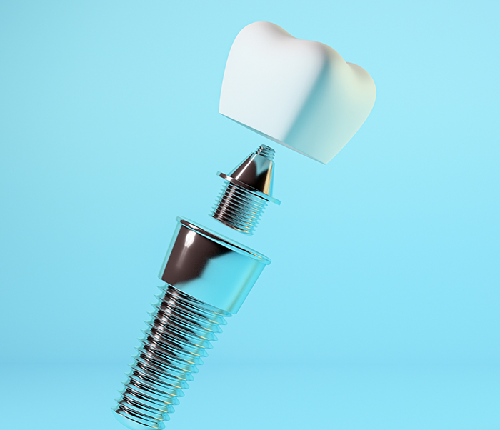 Illustration of a dental implant post with a dental crown and an abutment connector piece