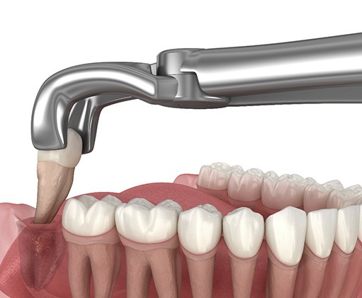Illustration of a tooth being extracted