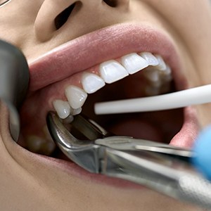 A woman getting a tooth extracted