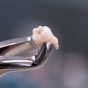An extracted tooth in a forcep