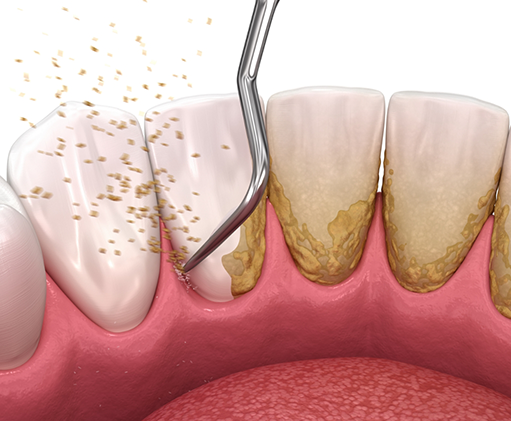 Illustration of a dental scaler clearing tartar buildup from the gumline