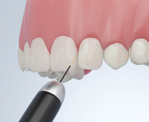 Illustration of a dental laser treating swollen gums