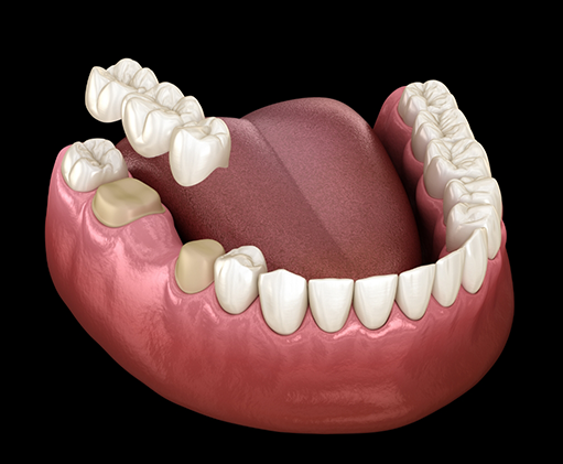 Illustration of a dental bridge being placed over two teeth to fill the gap between them