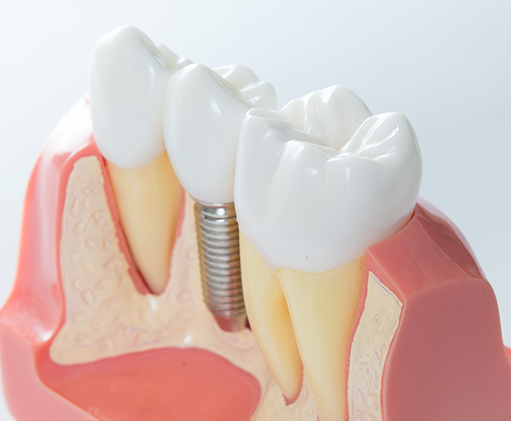 Model of a dental implant with a crown in between two natural teeth