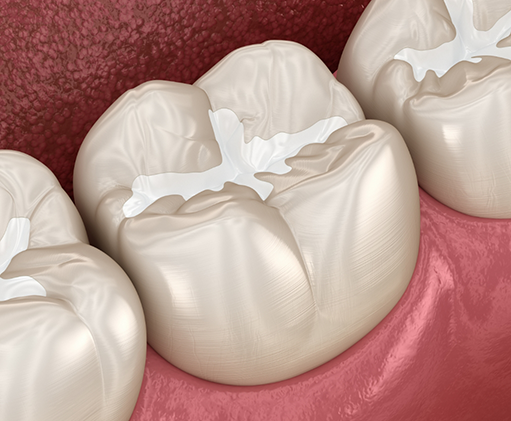 Illustration of a tooth with a white filling