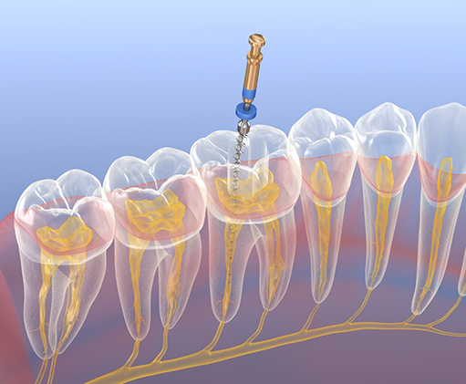 Illustration of a dental instrument treating the inner layer of a tooth