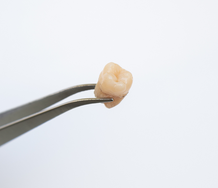 Tweezers holding an extracted tooth