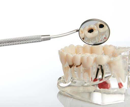 Dental mirror reflecting a badly damaged tooth in a model of the mouth