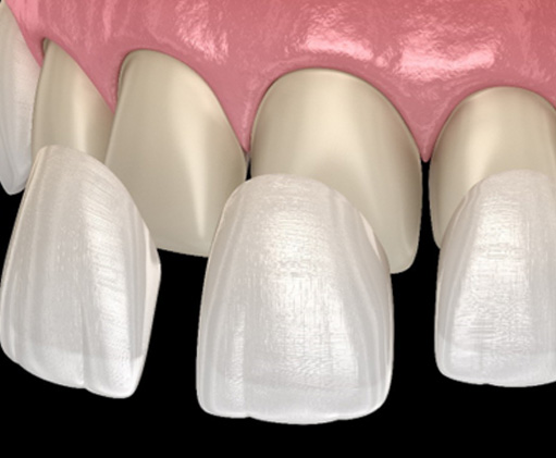 Illustration of veneers being placed on prepared teeth