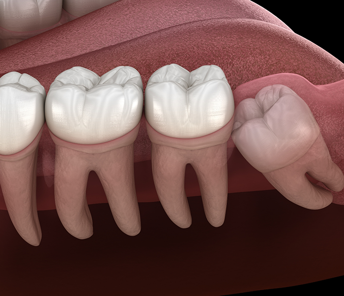Illustration of an impacted wisdom tooth pressing against the adjacent tooth