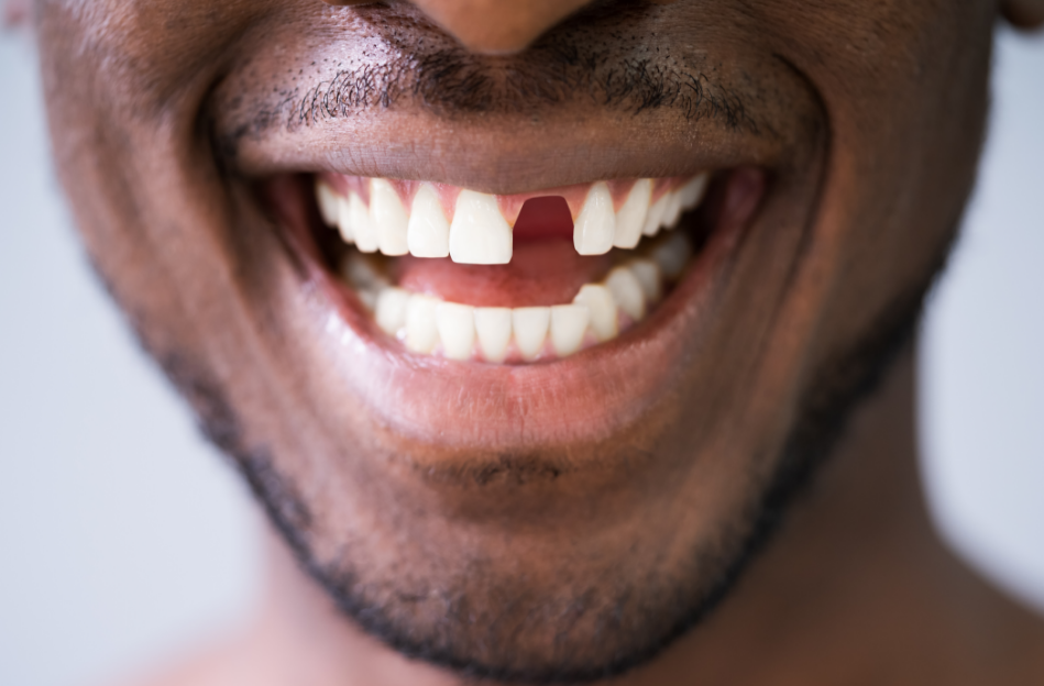 Close up of man missing tooth