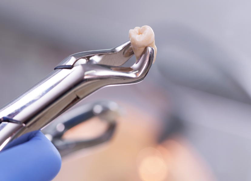 Tooth on forceps