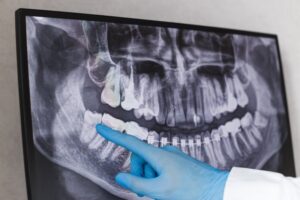 Dentist pointing to wisdom tooth on dental X-ray