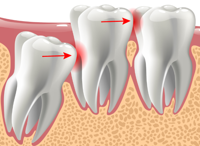Illustrated cross section of wisdom teeth